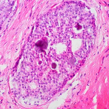 Breast_Ductal_Carcinoma_in_Situ_With_Calcifications_(5436471236)