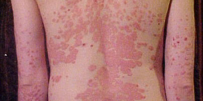 The Wednesday Island - http://en.wikipedia.org/wiki/Image:Psoriasis_on_back.jpg, CC BY-SA 3.0, https://commons.wikimedia.org/w/index.php?curid=1084344